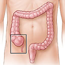 The location of the appendix in the body