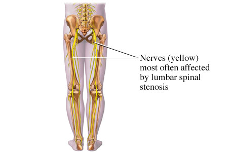 Picture of nerves affected by lumbar spinal stenosis