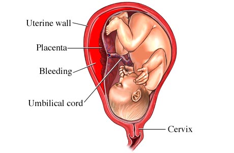 Picture of placenta abruptio