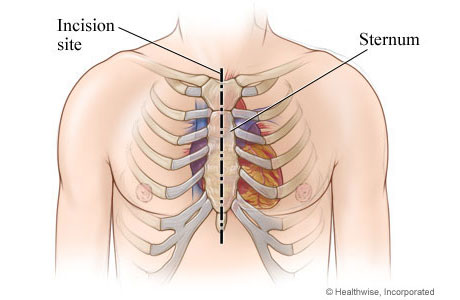 Chest incision site for aortic valve replacement surgery