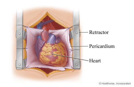 Heart exposed for aortic valve replacement