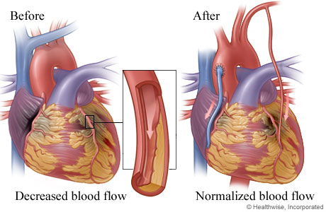 Decreased blood flow caused by narrowed or blocked artery before surgery and normal blood flow after surgery