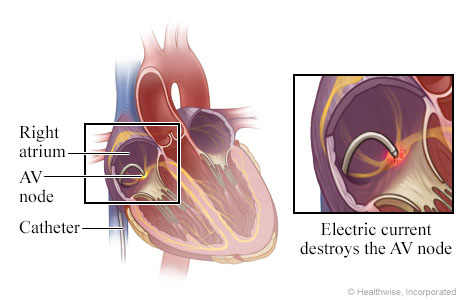 Location of catheter in the heart, with detail of electric current destroying AV node