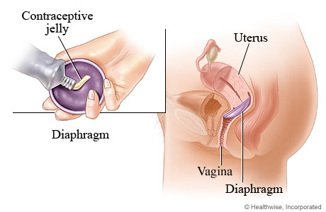 Diaphragm method of birth control