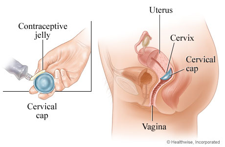 Cervical cap method of birth control