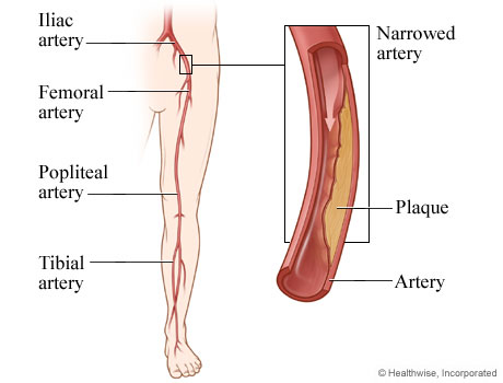 Peripheral arteries of the leg, with detail of the iliac artery narrowed by plaque