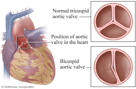 Location of aortic valve in heart, with details of a tricupsid valve and a bicuspid valve