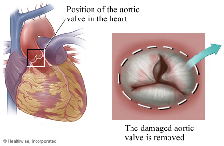 Location of aortic valve in the heart and detail of damaged valve