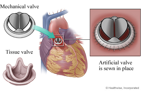 Mechanical and tissue aortic valves and detail of artificial valve sewn in place