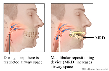 Mandibular repositioning device