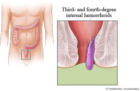 Picture of third- or fourth-degree hemorrhoid