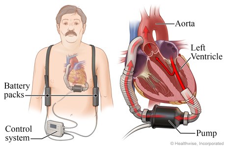 Location of pump, battery packs, and controller, with detail of LVAD pumping blood from the heart