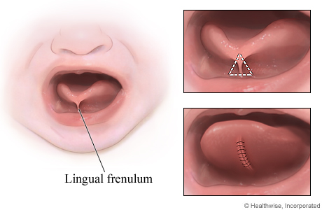Picture of a frenuloplasty for tongue-tie
