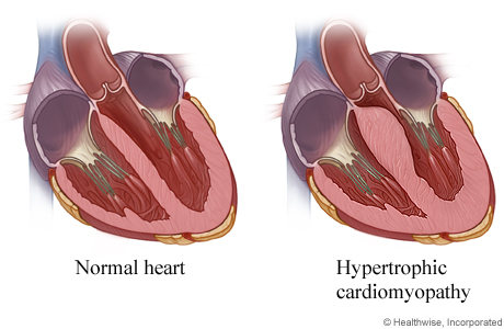 Heart cross section showing hypertrophic cardiomyopathy