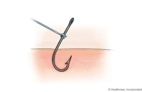 String-pull method for removing a fishhook, step A: Tie a piece of string to the hook