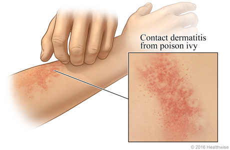 Contact dermatitis on an arm, with close-up of rash