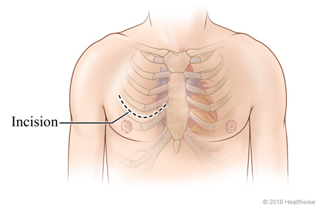 Chest incision site between ribs for less invasive surgery