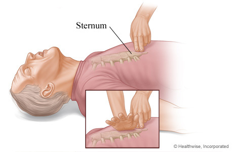Picture of where to place hands on sternum for chest compressions