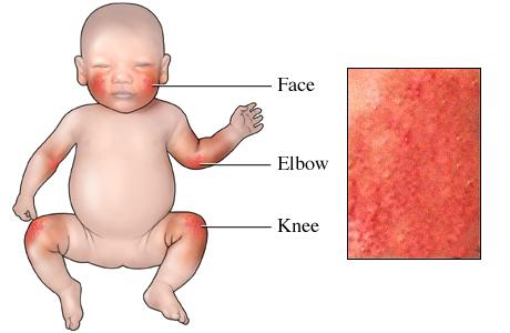 Picture of eczema (atopic dermatitis) in an infant