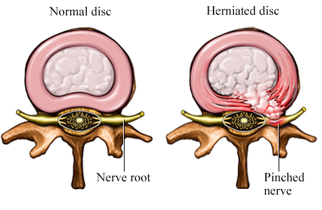 Picture of a normal disc compared to a herniated disc (cross section)