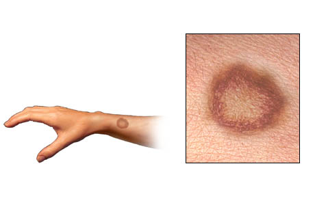 Ringworm skin rash