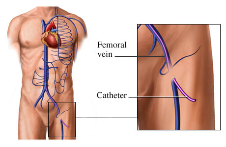 How a catheter is placed in the femoral vein