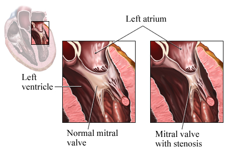 Picture of a normal mitral valve and a mitral valve with stenosis