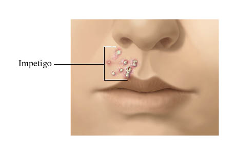 Impetigo sores between the upper lip and nose