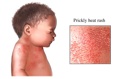 Prickly heat rash