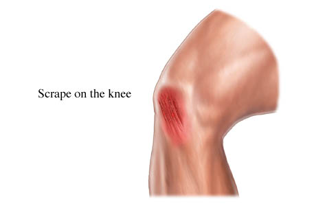 Picture of a scrape on the knee