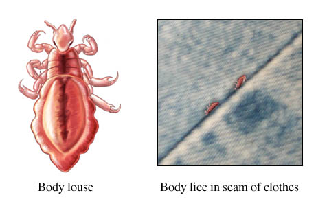 Body lice