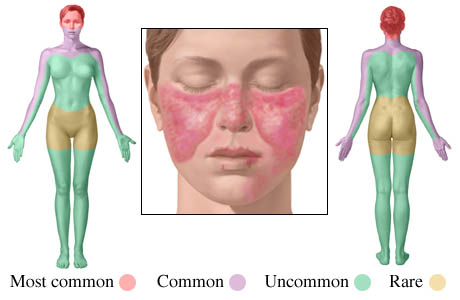 Picture of typical places where lupus rash appears