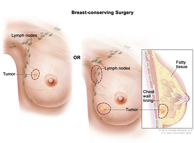 Breast-conserving surgery; the drawing on the left shows removal of the tumor and some of the normal tissue around it. The drawing on the right shows removal of some of the lymph nodes under the arm and removal of the tumor and part of the chest wall lining near the tumor. Also shown, is fatty tissue.