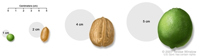 Tumor size compared to everyday objects; shows various measurements of a tumor compared to a pea, peanut, walnut, and lime.