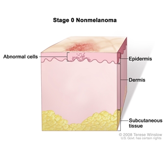 Stage 0 nonmelanoma skin carcinoma in situ; drawing shows skin anatomy with abnormal cells in the epidermis (outer layer of the skin). Also shown are the dermis (inner layer of the skin) and subcutaneous tissue below the dermis.