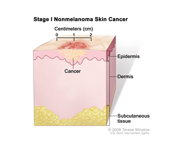 Stage I nonmelanoma skin cancer; drawing shows a tumor in the epidermis (outer layer of the skin) that is no more than 2 centimeters wide. Also shown are the dermis (inner layer of the skin) and the subcutaneous tissue below the dermis.