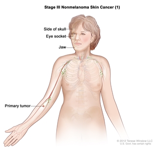 Stage III nonmelanoma skin cancer (1); drawing shows a primary tumor in one arm and parts of the body where it may spread, including the bones of the jaw, eye socket, or side of the skull.