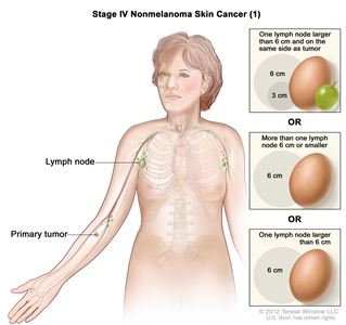 Stage IV nonmelanoma skin cancer (1); drawing shows a primary tumor in one arm with cancer in a lymph node on the same side of the body as the primary tumor. Insets show 3 centimeters is about the size of a grape and 6 centimeters is about the size of an egg.