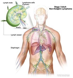 Stage I adult non-Hodgkin lymphoma; drawing shows cancer in one lymph node group above the diaphragm. An inset shows a lymph node with a lymph vessel, an artery, and a vein. Lymphoma cells containing cancer are shown in the lymph node.
