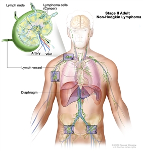 Stage II adult non-Hodgkin lymphoma; drawing shows cancer in lymph node groups above and below the diaphragm. An inset shows a lymph node with a lymph vessel, an artery, and a vein. Lymphoma cells containing cancer are shown in the lymph node.