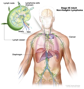 Stage IIE adult non-Hodgkin lymphoma; drawing shows cancer in one lymph node group above the diaphragm and in the left lung. An inset shows a lymph node with a lymph vessel, an artery, and a vein. Lymphoma cells containing cancer are shown in the lymph node.