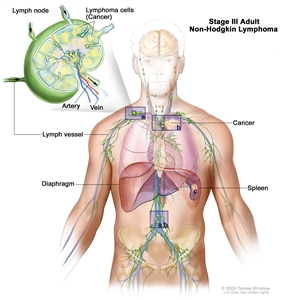 Stage III adult non-Hodgkin lymphoma; drawing shows cancer in lymph node groups above and below the diaphragm, in the left lung, and in the spleen. An inset shows a lymph node with a lymph vessel, an artery, and a vein. Lymphoma cells containing cancer are shown in the lymph node.