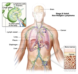 Stage IV adult non-Hodgkin lymphoma; drawing shows cancer in the liver, the left lung, and in one lymph node group below the diaphragm. The brain and pleura are also shown. One inset shows a close-up of cancer spreading through lymph nodes and lymph vessels to other parts of the body. Lymphoma cells containing cancer are shown inside one lymph node. Another inset shows cancer cells in the bone marrow.