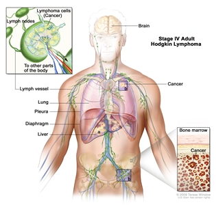 Stage IV adult Hodgkin lymphoma; drawing shows cancer in the liver, the left lung, and in one lymph node group below the diaphragm. The brain and pleura are also shown. One inset shows a close-up of cancer spreading through lymph nodes and lymph vessels to other parts of the body. Lymphoma cells containing cancer are shown inside one lymph node. Another inset shows cancer cells in the bone marrow.