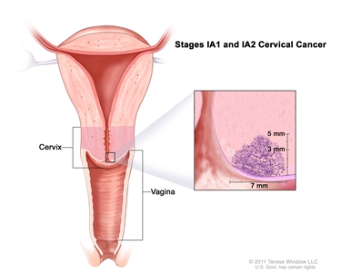 Stage IA1 and IA2 cervical cancer; drawing shows a cross-section of the cervix and vagina. An inset shows cancer in the cervix that is up to 5 mm deep, but not more than 7 mm wide.