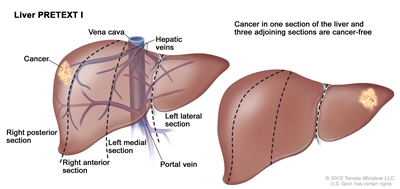 Liver PRETEXT I; drawing shows two livers. Dotted lines divide each liver into four vertical sections of about the same size. In the first liver, cancer is shown in the section on the far left. In the second liver, cancer is shown in the section on the far right.