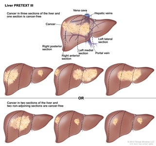 Liver PRETEXT III; drawing shows seven livers. Dotted lines divide each liver into four vertical sections that are about the same size. In the first liver, cancer is shown in three sections on the left. In the second liver, cancer is shown in the two sections on the left and the section on the far right. In the third liver, cancer is shown in the section on the far left and the two sections on the right. In the fourth liver, cancer is shown in three sections on the right. In the fifth liver, cancer is shown in the two middle sections. In the sixth liver, cancer is shown in the section on the far left and the second section from the right. In the seventh liver, cancer is shown in the section on the far right and the second section from the left.