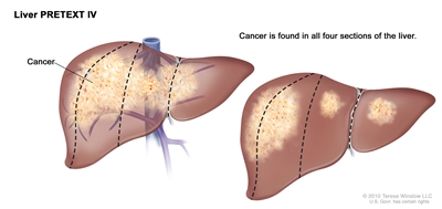 Liver PRETEXT IV; drawing shows two livers. Dotted lines divide each liver into four vertical sections that are about the same size. In the first liver, cancer is shown across all four sections. In the second liver, cancer is shown in the two sections on the left and spots of cancer are shown in the two sections on the right.