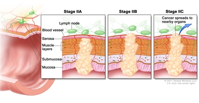Stage II colorectal cancer; shows a cross-section of the colon/rectum and a three-panel inset. Each panel shows the layers of the colon/rectum wall: mucosa, submucosa, muscle layers, and serosa. Also shown are a blood vessel and lymph nodes. First panel shows stage IIA with cancer in the mucosa, submucosa, muscle layers, and serosa. Second panel shows stage IIB with cancer in all layers and spreading through the serosa. Third panel shows stage IIC with cancer spreading to nearby organs.