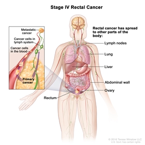 Stage IV rectal cancer; drawing shows other parts of the body where rectal cancer may spread, including lymph nodes, lung, liver, abdominal wall, and ovary. An inset shows cancer cells spreading from the rectum, through the blood and lymph system, to another part of the body where metastatic cancer has formed.